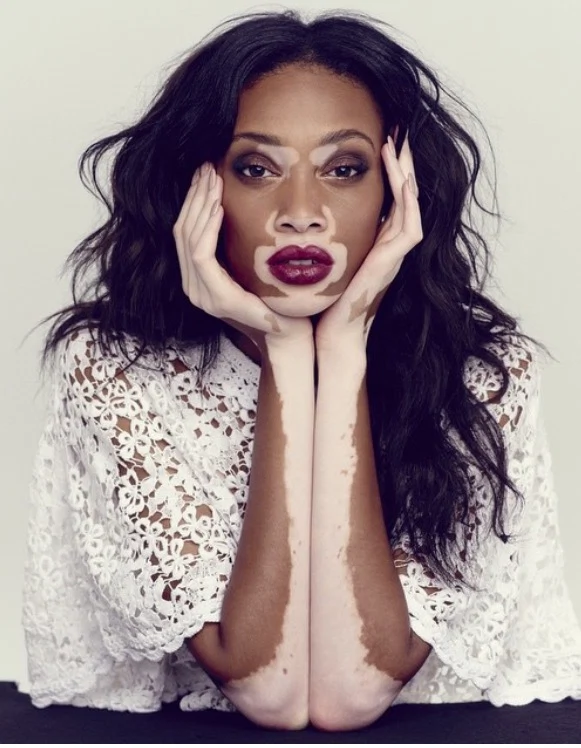 Winnie-Harlow-Beauty