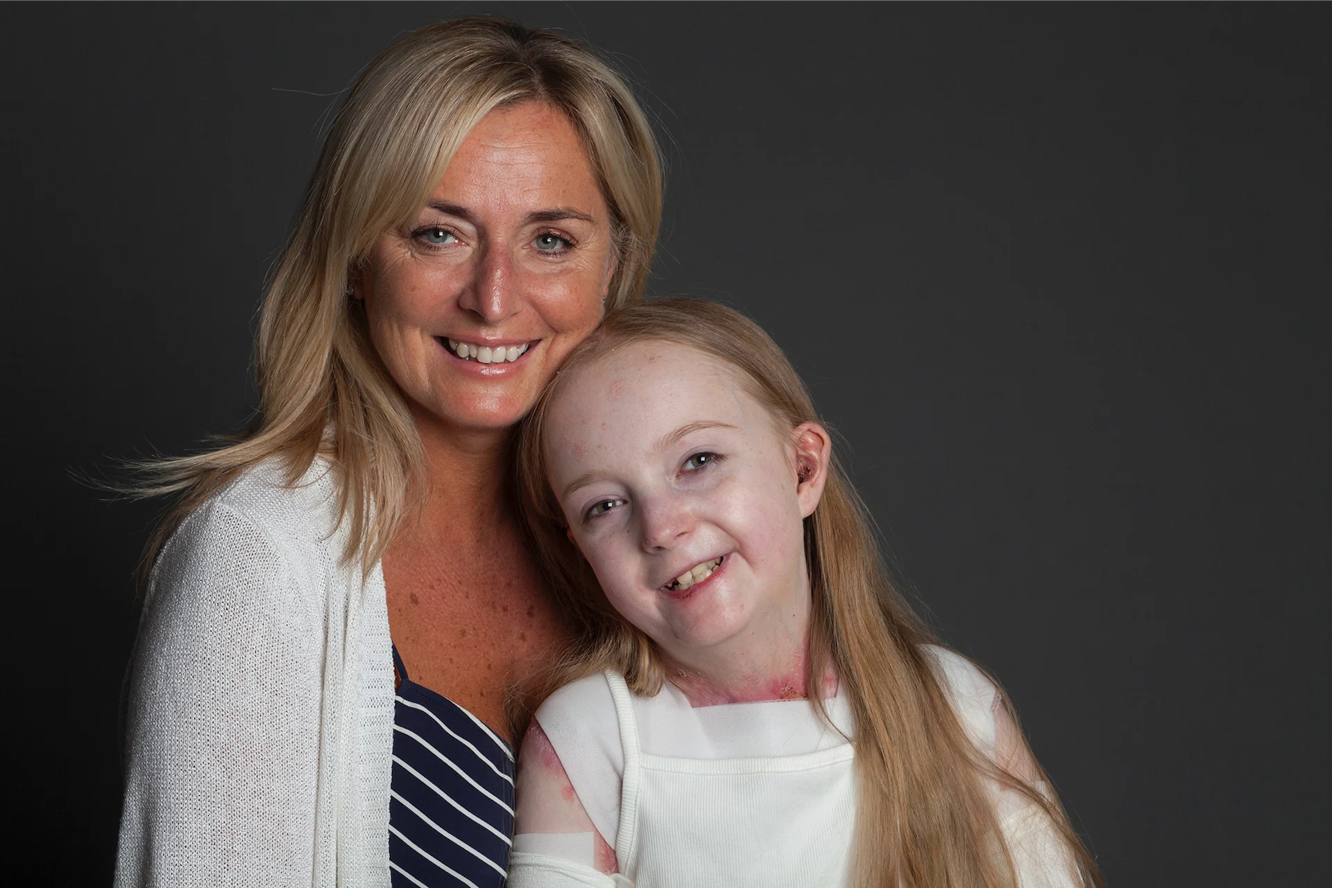 Irish teen Claudia to compete in marathon to help raise funds for others with rare skin condition