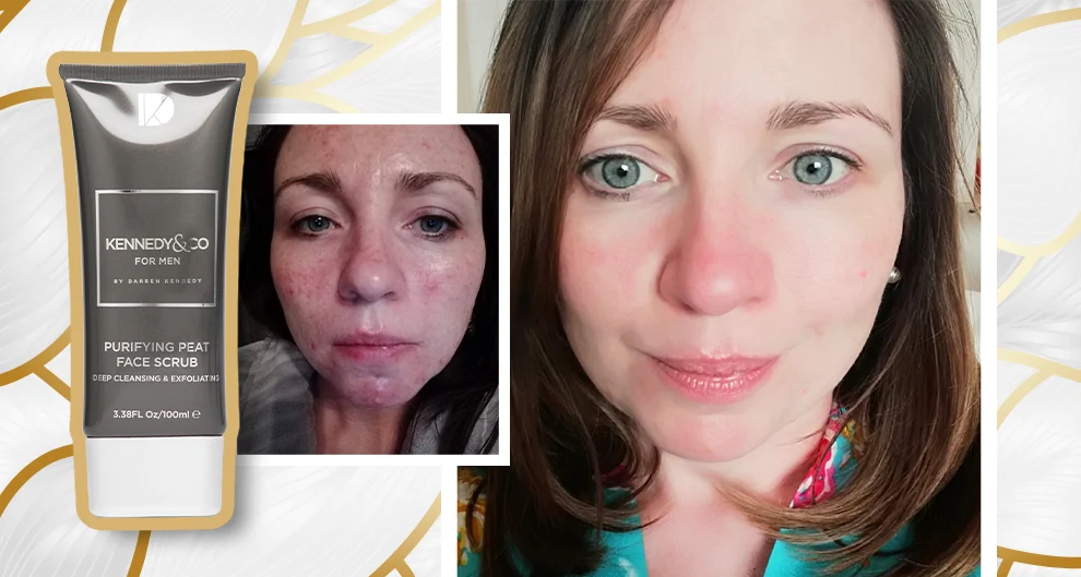 ‘This face scrub was the only product that reduced my acne’ – and it’s Irish-made