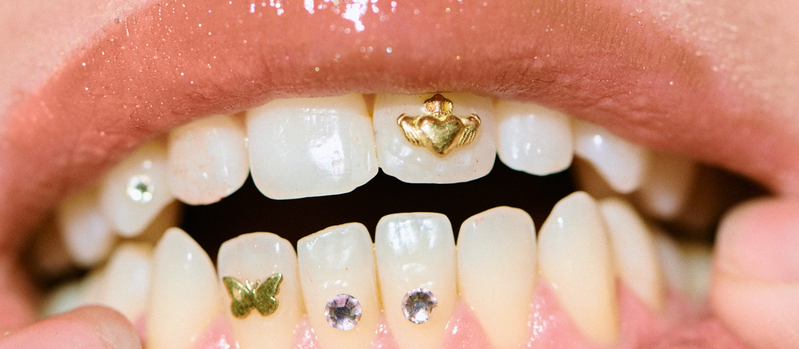 The rise of teeth gems on the Irish scene